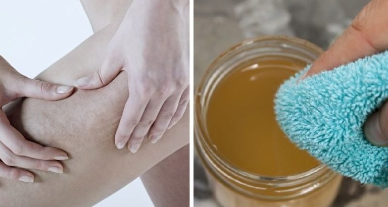 Celulitis1