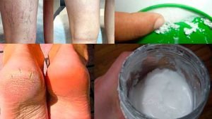 ignis-natura-salud-callos-pies-varices.jpg
