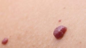 Util e interesante que salen puntos rojos piel y como prevenir su aparicion n351582 624x352