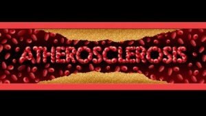Arteriosclerosis sintomas tratamiento 576x324