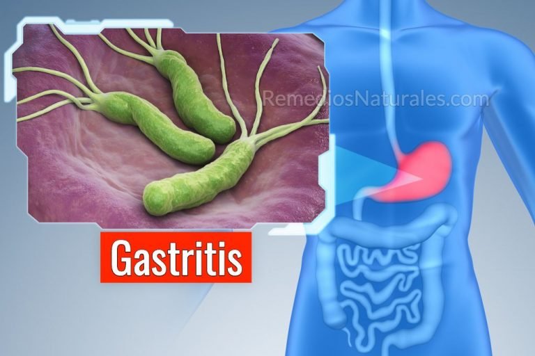 Remedios para la gastritis