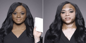 Vitiligo