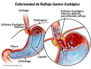 Reflujo