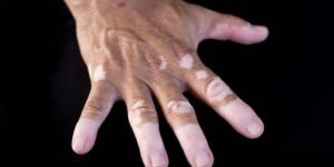 Vitiligo 4117b2e47f8e4c0a8d7e82cbd939bd7f 1200x600