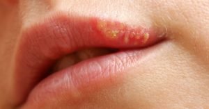 Herpes labial