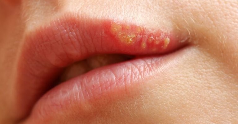 Herpes labial