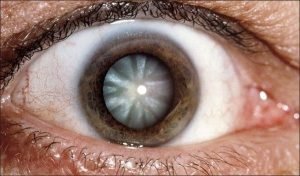 Ojo catarata e1441185149546