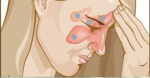 sinusitis