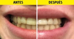 dientes