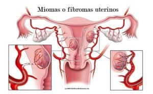 ignis-natura-salud-miomas