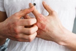 dematitis