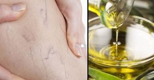 varices y su remedio