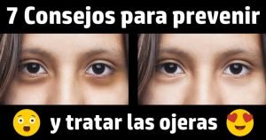 ojeras