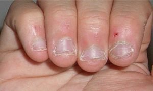 morder las uñas