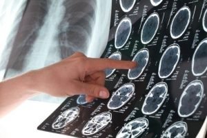accidente cerebrovascular