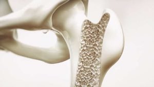 intestino inflamado