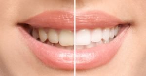 Blanqueamiento dental