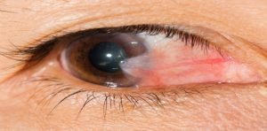 Elimina esas carnosidades de tus ojos de forma rápida y natural