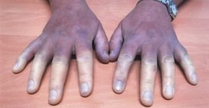 esclerodermia-ignis-natura