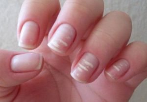 rayas blancas uñas