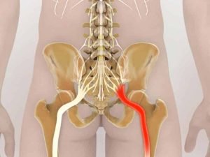 Cómo aliviar el malestar del nervio ciático con 3 simples ejercicios
