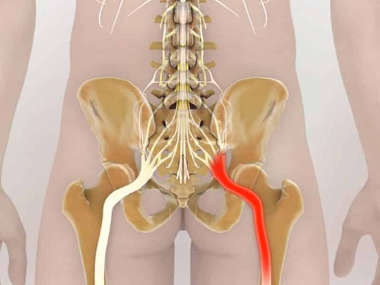 Cómo aliviar el malestar del nervio ciático con 3 simples ejercicios