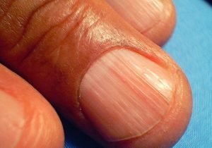 Estrías y Rayas en las Uñas