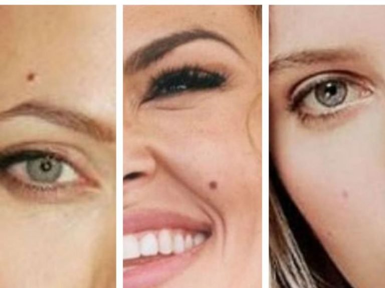 lunares-significado-simbolismo-melanoma-ignis-natura