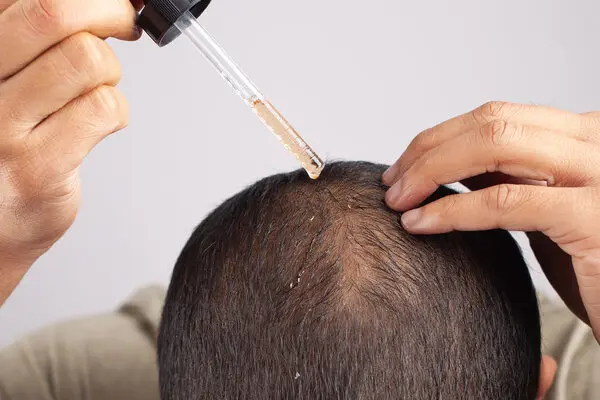 Adiós a la Calvicie: El Poderoso Remedio Casero que Detiene la Caída del Cabello y Estimula su Crecimiento