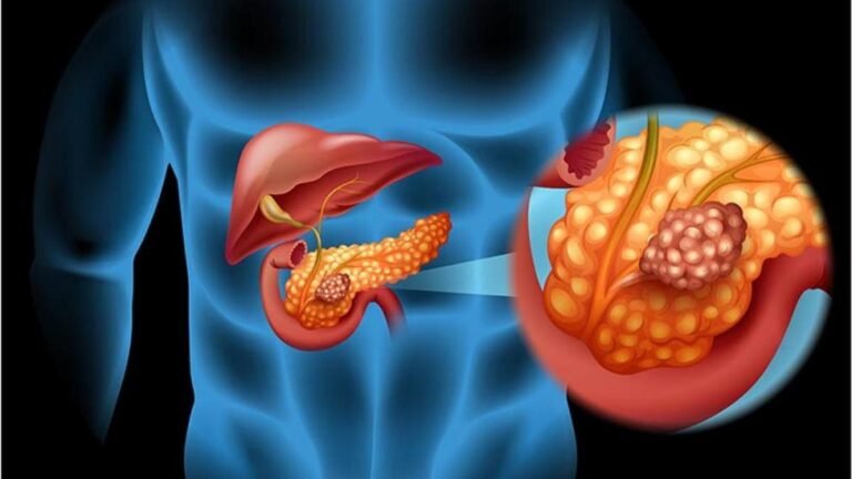 cancer-pancreas-sintomas-tempranos-ignis-natura