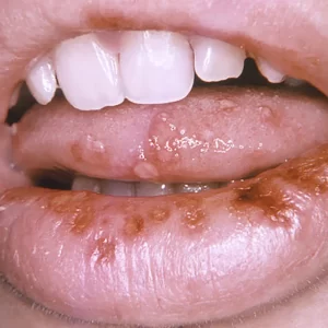 herpes-significado-porque-salen-ignis-natura