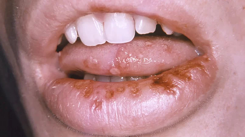 herpes-significado-porque-salen-ignis-natura