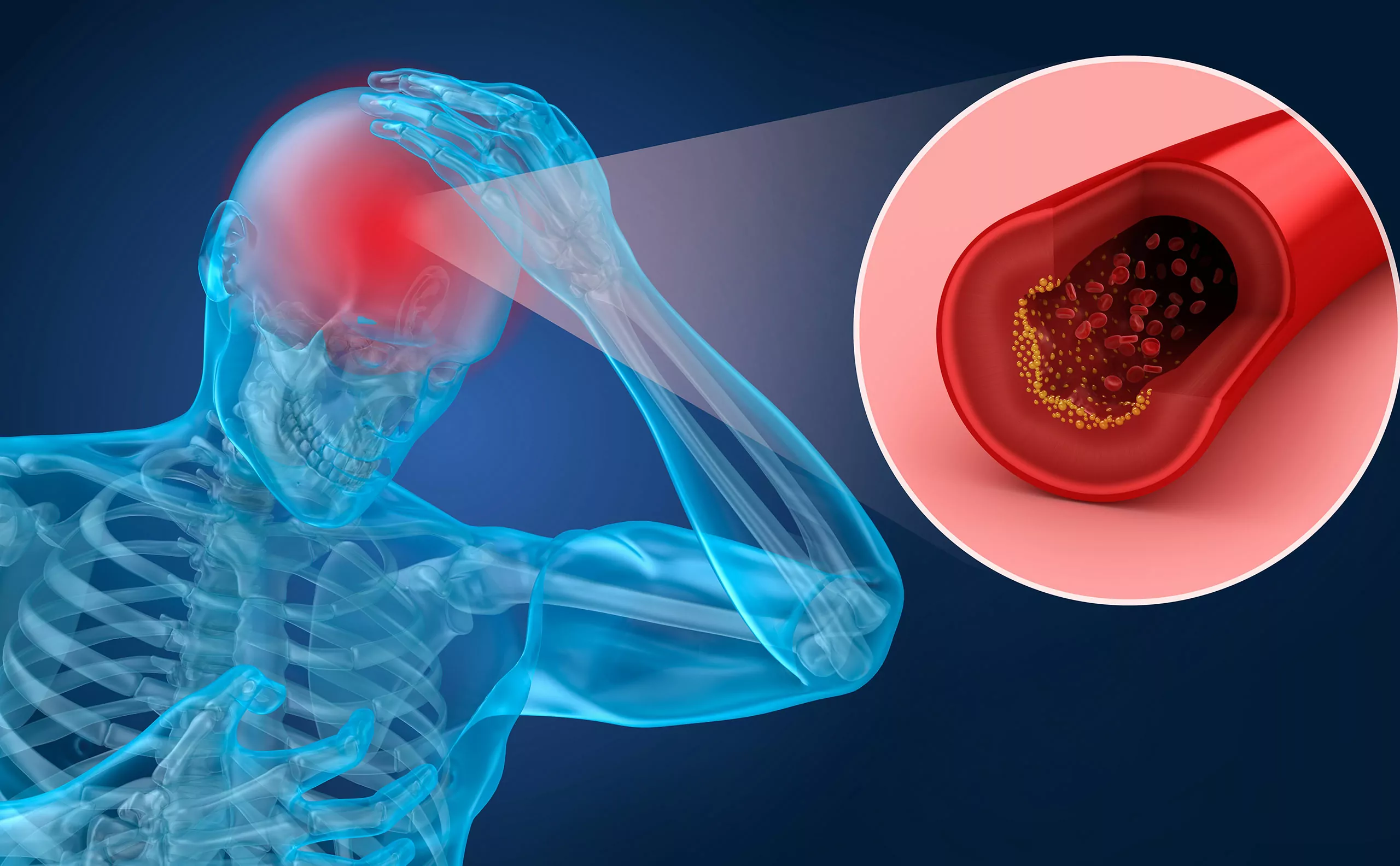 Señales de un Derrame Cerebral: Cómo Detectarlo con Anticipación