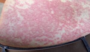 urticaria-síntomas-remedio-natural-ignis-natura