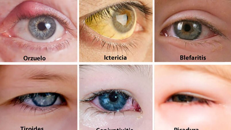 ojos-salud-debes-saberlo-ignis-natura