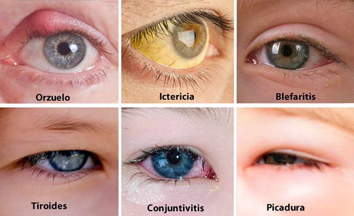 ojos-salud-debes-saberlo-ignis-natura