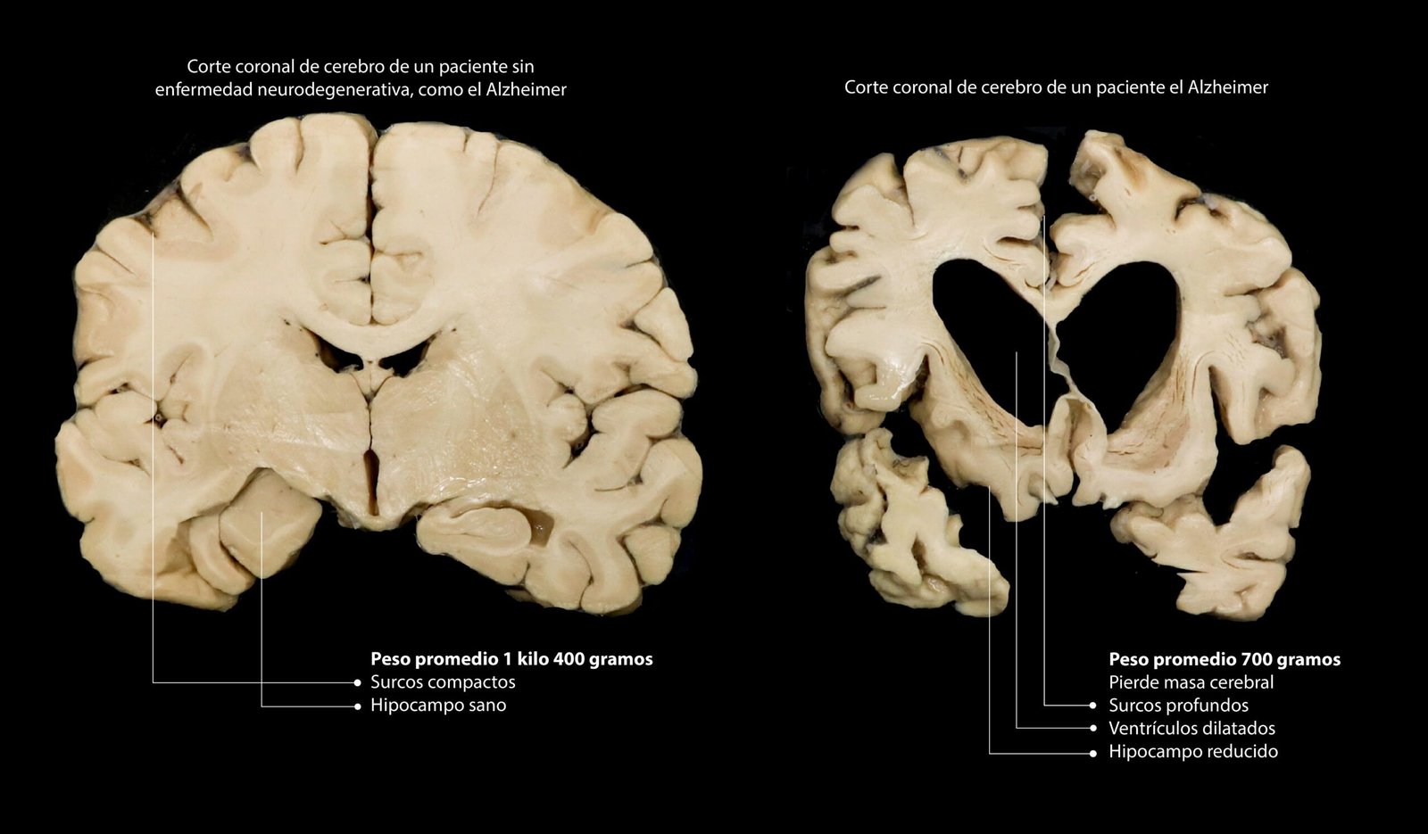 La diferencia entre un cerebro normal y uno con Alzheimer