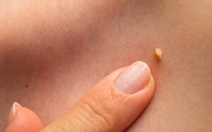 VPH: Conociendo el Virus, Síntomas y Remedios Naturales para Combatirlo