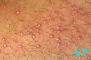 Foliculitis comezón del barbero 02 piel icd 10 l73.9 1024x675