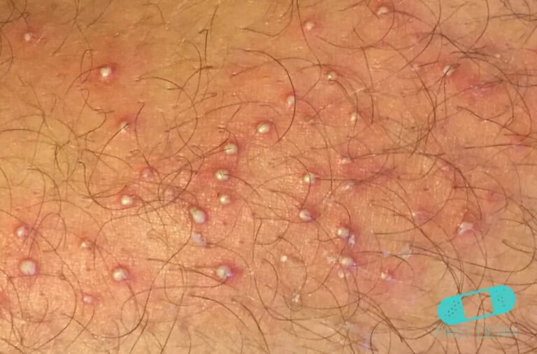 Foliculitis comezón del barbero 02 piel icd 10 l73.9 1024x675