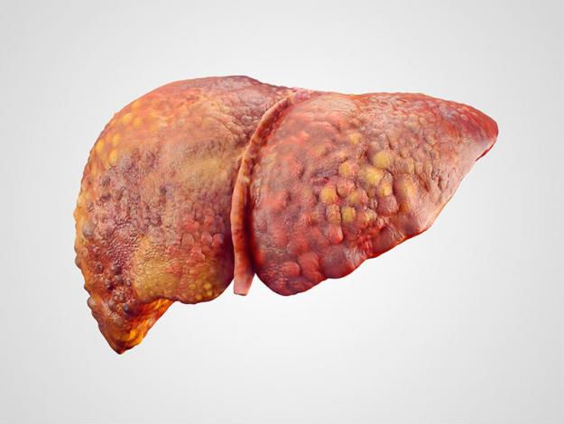 Síntomas de la Cirrosis y Cómo Prevenirla de Forma Natural