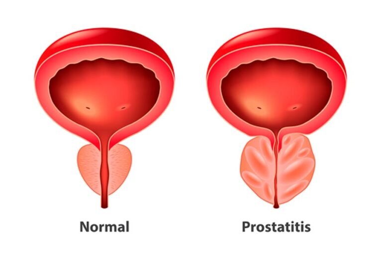 Como prevenir la prostatitis