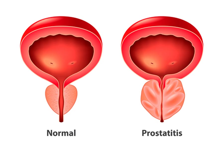 Síntomas de la Prostatitis y cómo combatirla naturalmente