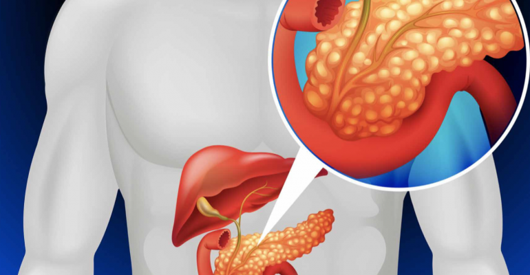 Síntomas de Pancreatitis y Cómo Combatirla de Forma Natural