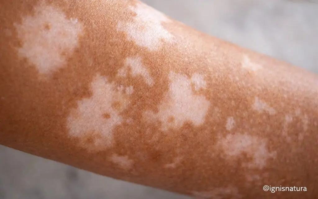 Manchas blancas en la piel sin razón aparente: 7 causas sorprendentes que debes conocer hoy