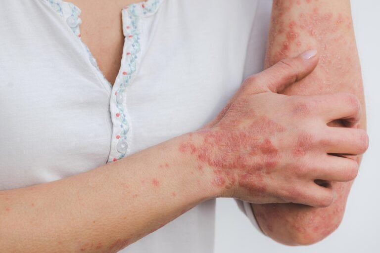 Psoriasis 5996424